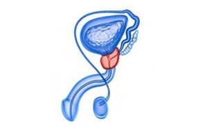 drawing of inflammation of the prostate