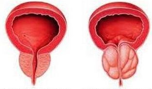 Healthy and inflamed prostate